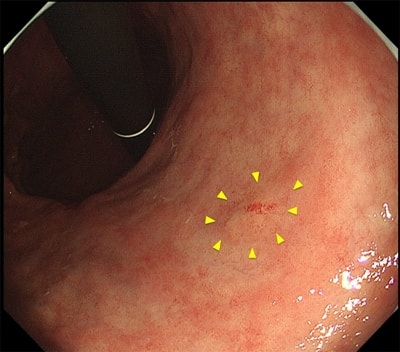 胃がんの早期発見について：画像1