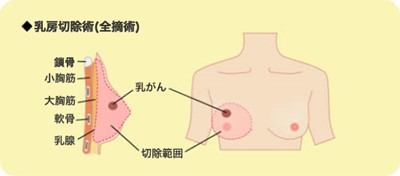 乳がんの手術4.gif.jpg