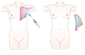 乳房再建手術2.gif
