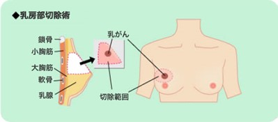 乳がんの手術3.jpg