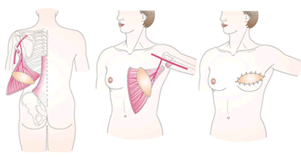 乳房再建手術1.gif